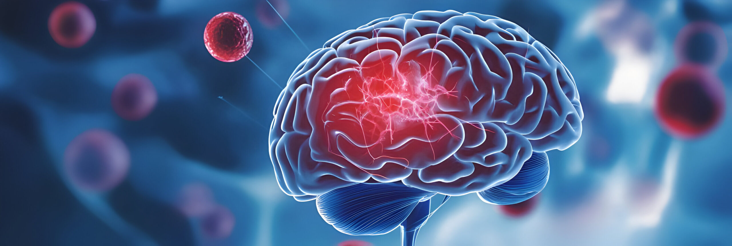 Cómo Prevenir un Evento Cerebrovascular Imagen de un cerebro posiblemente afectado